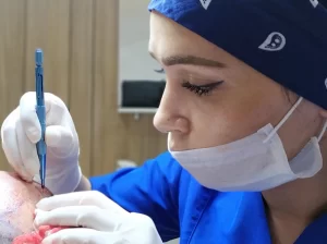 Sapphire FUE Hair Transplant