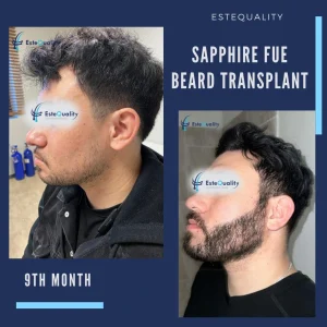 EsteQuality Beard Transplant Turkey before after