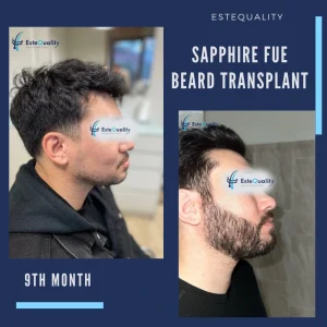 Beard transplant Turkey before after